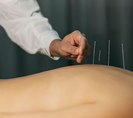 Akupunktur mod høfeber og allergi