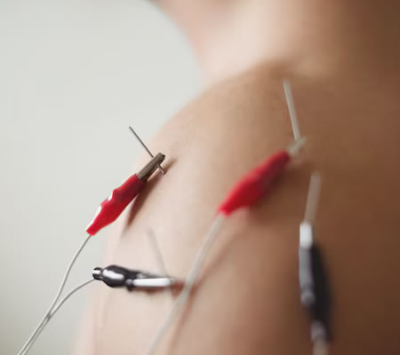 akupunktur mod smerter