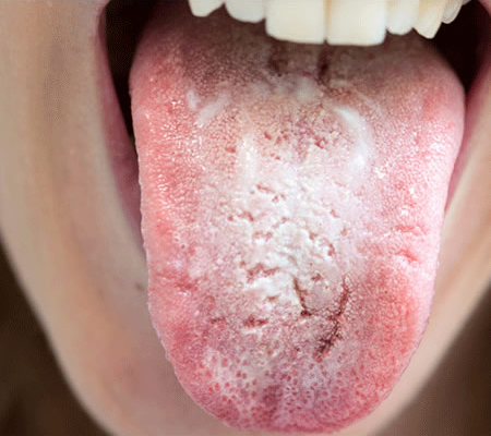 Candida svamp