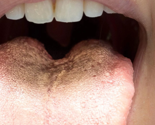 candida tungesvamp