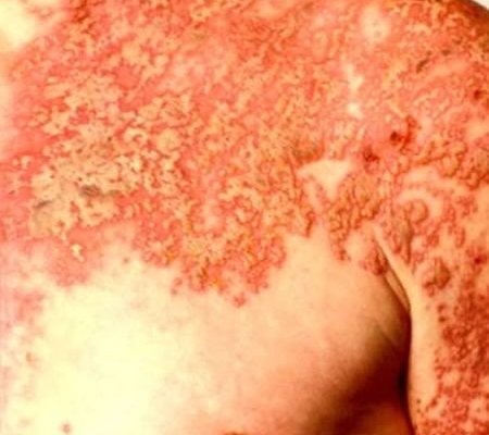 herpes zoster