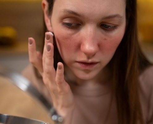 psoriasis