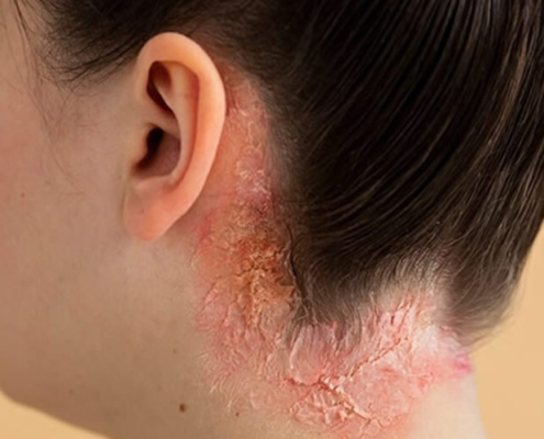 psoriasis i nakken