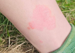 Psoriasis på ben