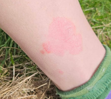 Psoriasis