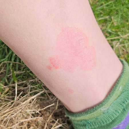 Psoriasis på ben