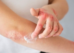 psoriasis på arm