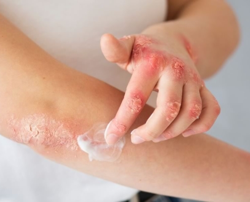 Gode Råd psoriasis