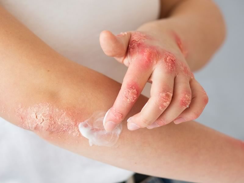 psoriasis på arm