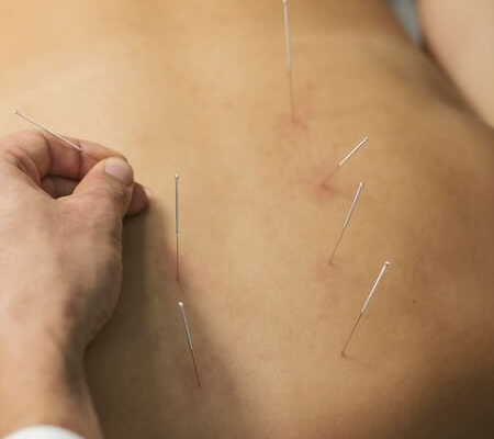Akupunktur virker det